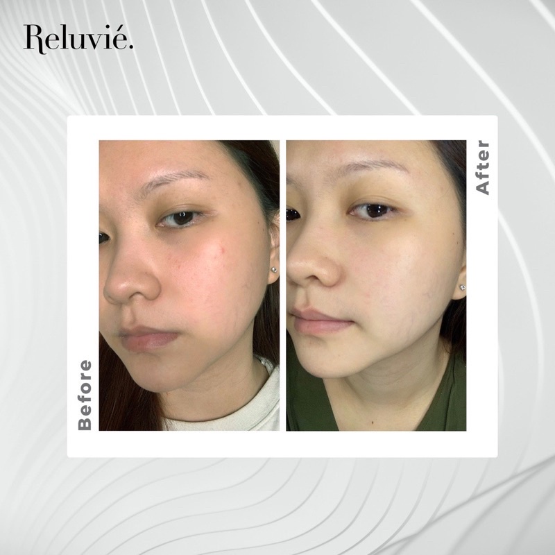 RELUVIE Acne Serum 10ml / 20ml BPOM Serum Jerawat