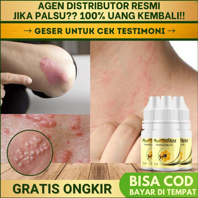 Obat Gatal Kulit Menahun Herbal Infeksi Jamur Alergi Propolis SM