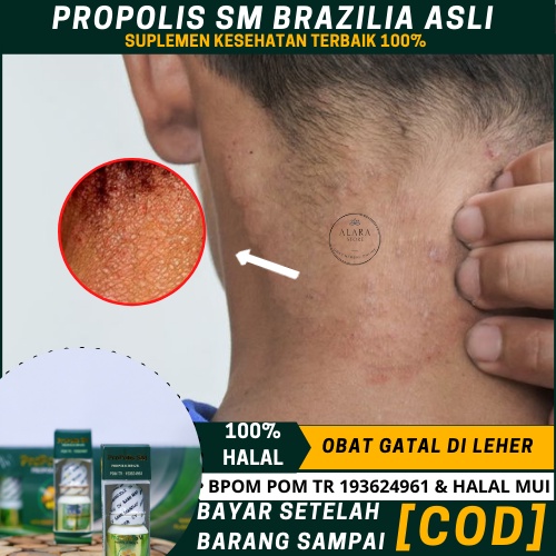 Obat Gatal Di Leher, Leher Merah, Iritasi Leher, Ruam Merah Di Leher Belakang, Gatal Di   Lipatan Le