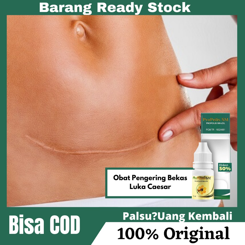 Obat Pengering Bekas Luka Caesar , Luka Sesar Bernanah , Luka Dalam Pasca Operasi | PROPOLIS SM