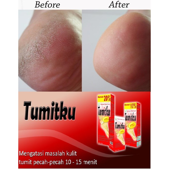 TUMITKU OBAT KAKI PECAH 30 ml | SOLUSI KAKI PECAH KAPALAN | ORIGINAL BPOM 100%