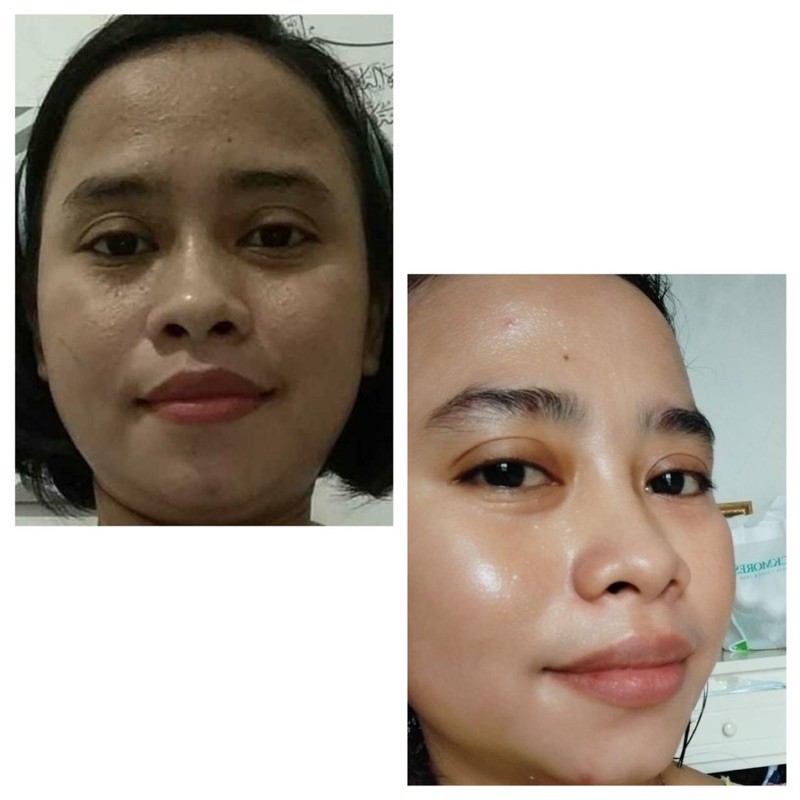 {BANYAK GIFT} BENINGS SKINCARE BRIGHTENING DAN ACNE (bening’s clinic)