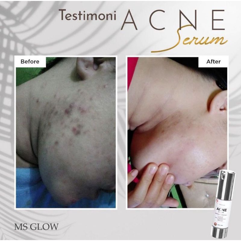 SERUM MS GLOW / SERUM LUMINOUS MS GLOW / SERUM LIFTHING MS GLOW / SERUM ACNE / GOLD SERUM WAJAH