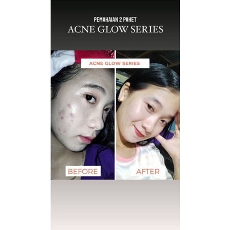 LASKIN PAKET ACNE GLOW SERIES ( FREE POUCH )-3