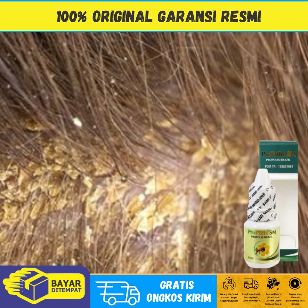 Obat Ketombe Berkerak Parah, Obat Kulit Kepala Gatal, Obat Borok di Kepala, Obat Ketombe Rambut Ront
