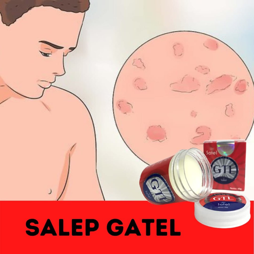 ASLI Salep Gatel GTL ampuh obati gatel