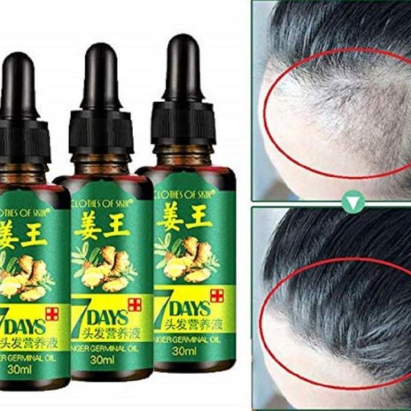 GINGER HAIR GROWTH ESSENCE HAIR SERUM PENUMBUH RAMBUT ANTI RONTOK TERBUKTI  1000%