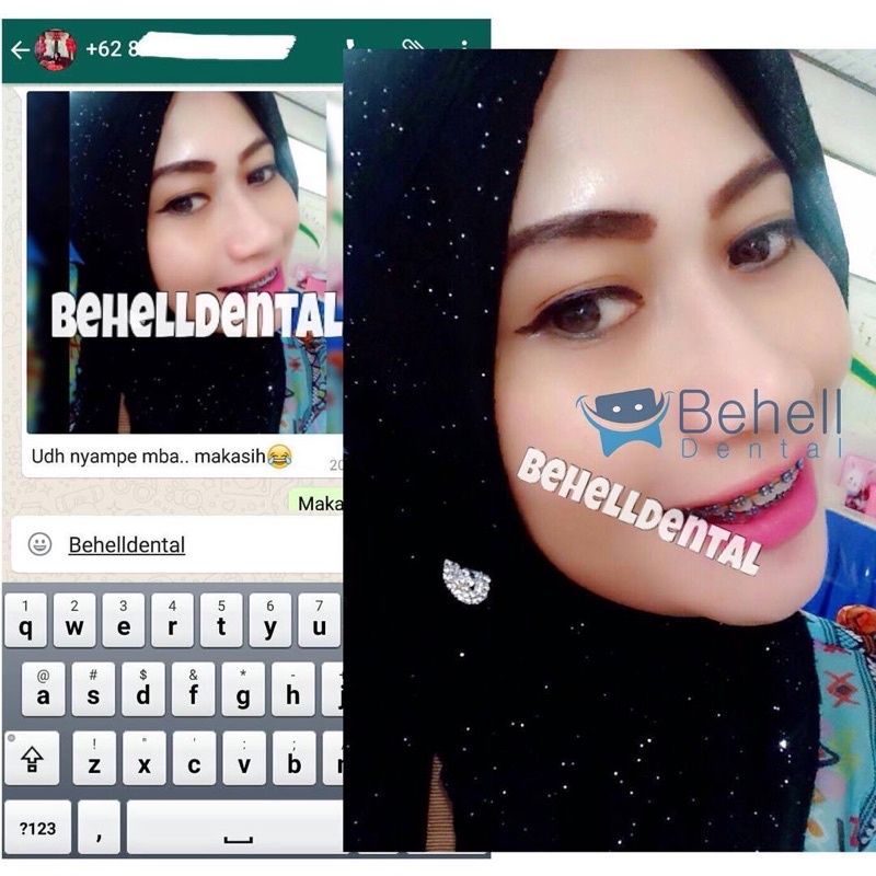 ORIGINAL BRACKET BEHEL METAL ORTHO FDA / AEGIS / GEOUSIS / LUXURY MINI ROTH MENGKILAP WITH HOOK - Dental Braces Orthodontic Untuk Perbaikan / Perawatan Gigi - Kawat - ANTI KARAT - Metalic - BEHELLDENTAL