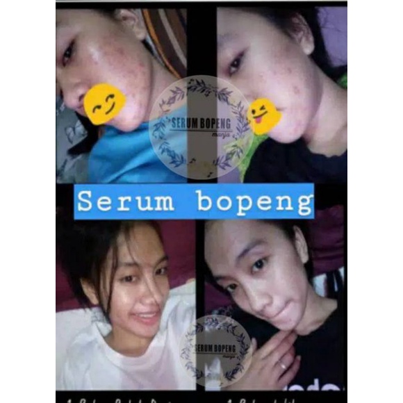 Serum Bopeng Manja Original