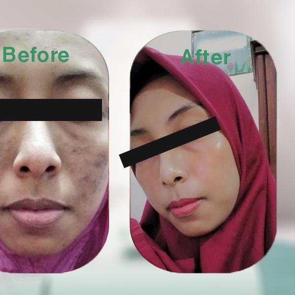 ➨ Lavees Cosmedics - AX Night Cream [Krim Malam Jerawat] ➺