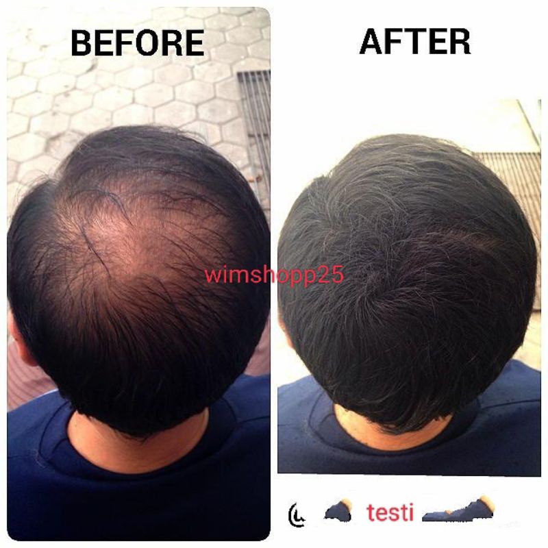 MINYAK KEMIRI PENUMBUH RAMBUT/MENGURANGI RAMBUT RONTOK