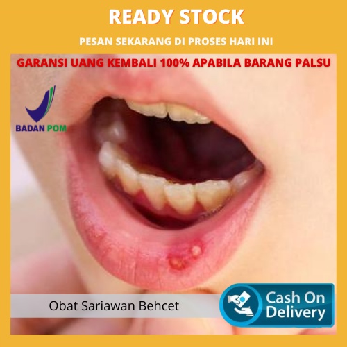 Obat Sariawan Meradang, Obat Sariawan, Obat Sariawan Di Bibir, Obat Sariawan Akut, Obat Sariawan Par