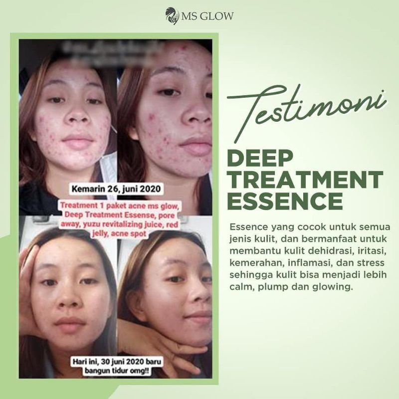 MS Glow Deep Treatment ESSENCE/ MS Glow Deep ESSENCE Treatment Original Penghilang Jerawat Permanen