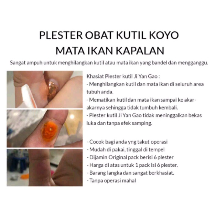 [BISA COD] Plester Kutil Mata Ikan Kaki Kapalan Ji Yan Gao Obat Kutil Mata Ikan Kaki Kapalan (1 Box Isi 6pcs)