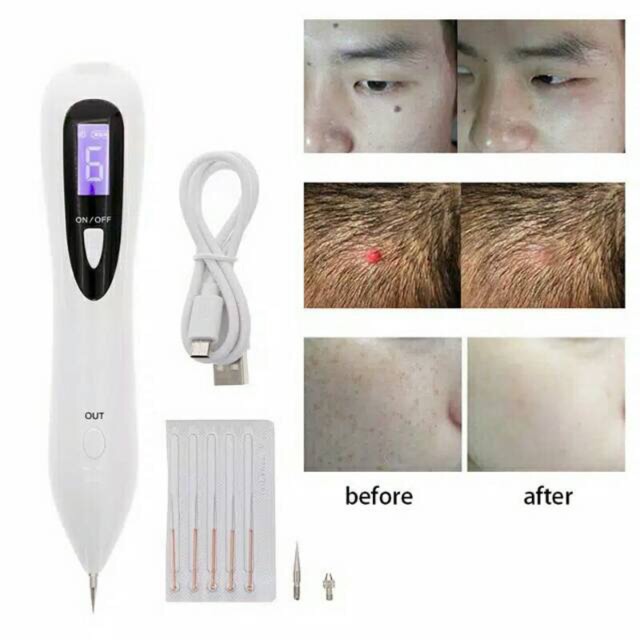 Laser penghilang flek/jerawat/tahi lalat