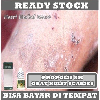 Obat Scabies, Kudis Budug Gudig Budukan, Kutu Scabies, Bentol Berisi Air Dan Nanah Pada Jari Tangan dan Kaki, Gatal di Pantat, Korengan, Eksim Kering/ Basah, Eksim Menahun Dengan Propolis SM Brazil