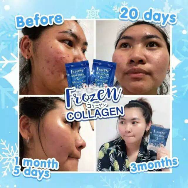 Frozen collagen