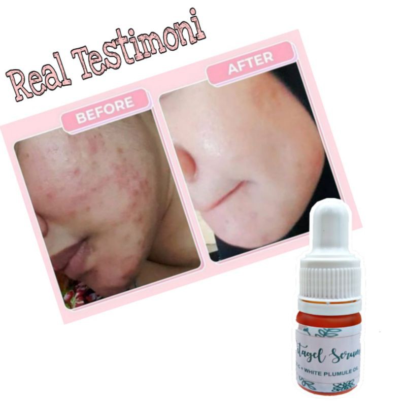 PROMO | Vitagel Serum | Boster Ampuh Angkat Flek Hitam