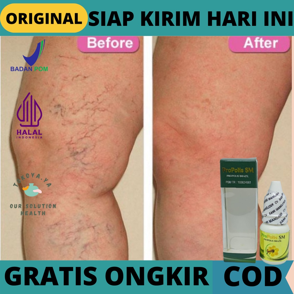 Obat Varises Kaki, Obat Varises Betis, Obat Herbal Pengobatan Varises kaki, Obat Penghilang Parises,