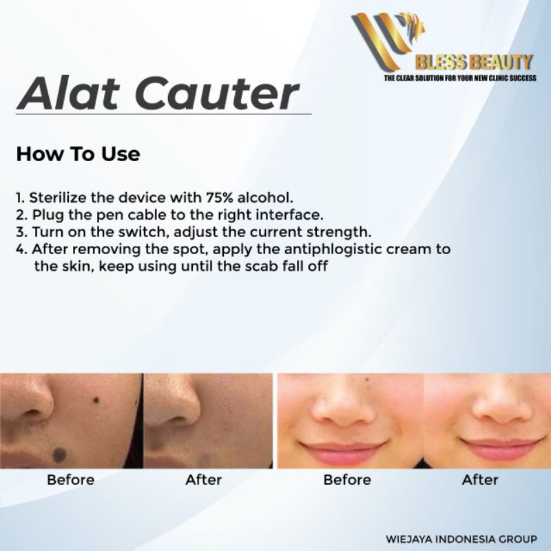 Alat Penghilang Black Spot Tatto Kutil Flek Melasma Soft Cauter Removal