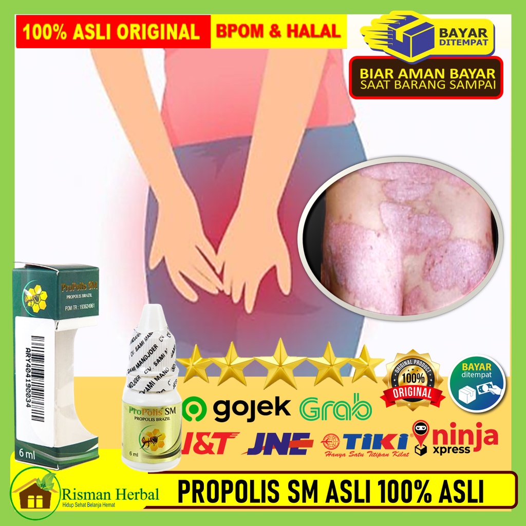 Obat Pantat Gatal Gatal, Pantat Bruntusan, Obat Pantat Korengan Obat Pantat Burik Gatal Dan Perih, J