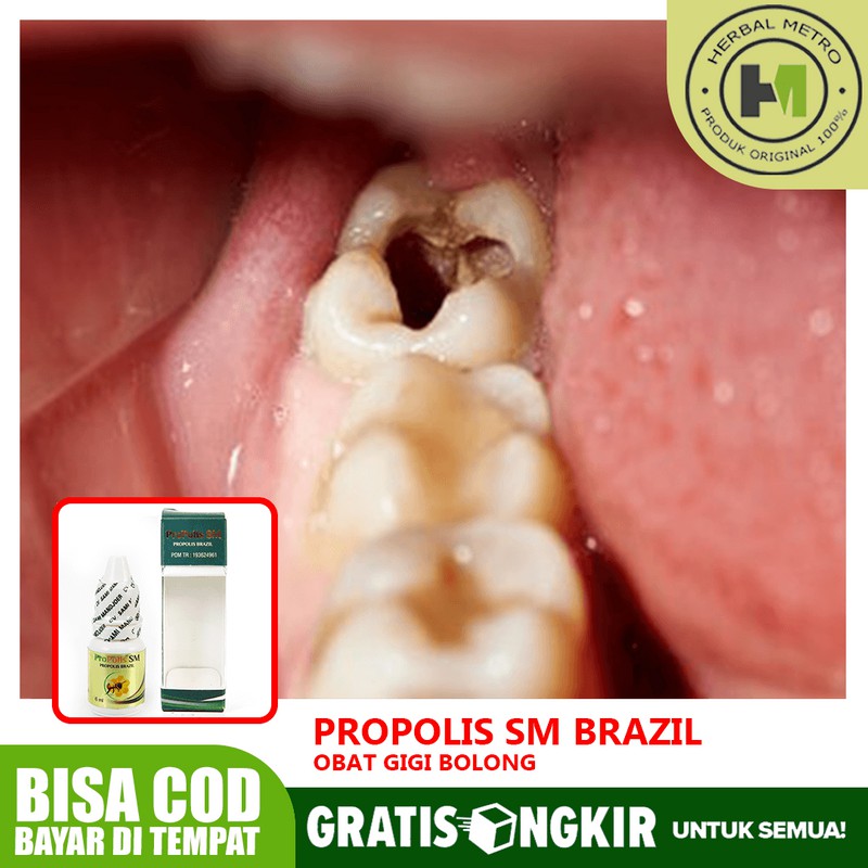 Obat Gigi Bolong Gigi Keropos Gigi Ngilu Anak Dan Dewasa Herbal Propolis Sm Shopee Indonesia