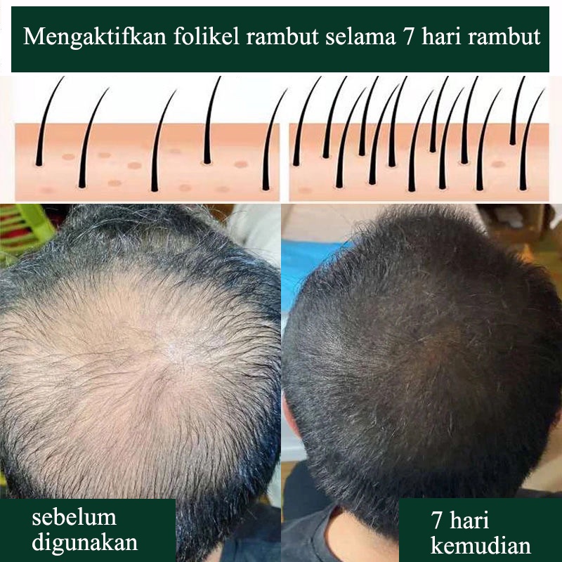 penumbuh rambut serum 30ml hair care Cepat dan efektif anti kebotakan/pertumbuhan rambut/perawatan kulit kepala/penebalan rambut