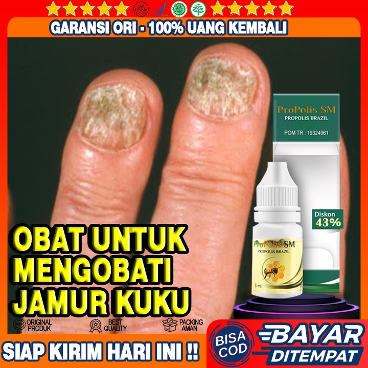 Obat Untuk Mengobati Jamur Kuku, Jamur Kuku, Pitting Kuku, Psoriasis Kuku - Propolis SM Original