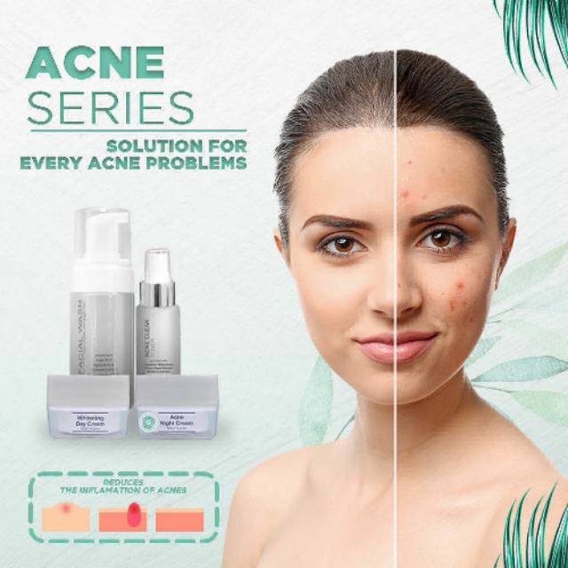 Acne series skin care by ms glow