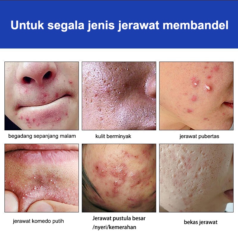 Serum Acne Obat Jerawat Obat Totol Jerawat 30g Herbal Obat Jerawat Dan Bekas Jerawat Obat Jerawat Dan Bekas Jerawat Paling Ampuh