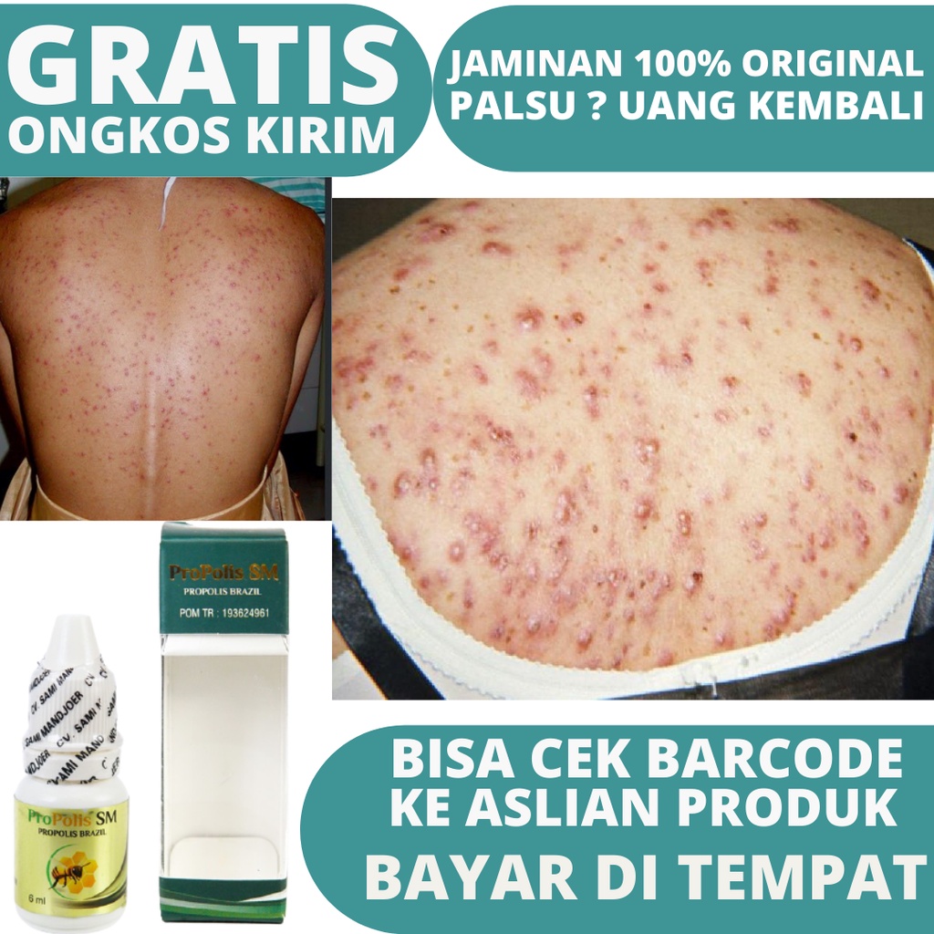 obat jerawat punggung, obat jerawat, obat jerawat pria, obat jerawat herbal, jerawat punggung, obat 