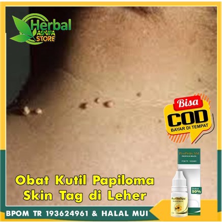Asyifaherbalstore Herbal Penghilang Papiloma di Leher, Daging Tumbuh, Obat Papiloma di Leher dan Waj