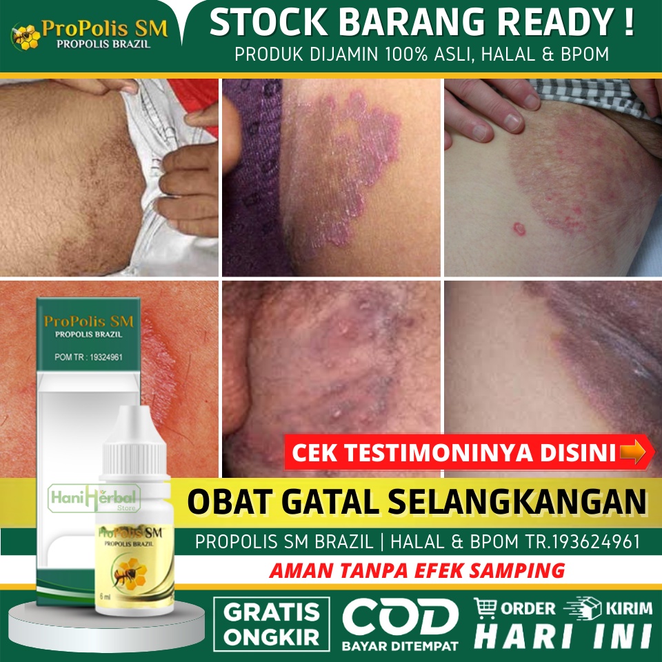 Obat Oles Untuk Gatal Gatal di Selangkangan, Selangkangan Bruntusan, Bokong Bruntusan, Bruntusan di 