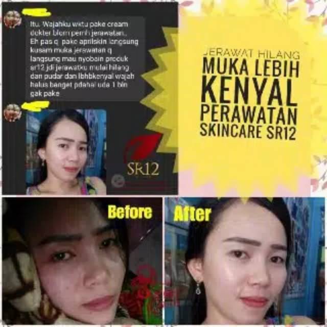 TUMPAS BEKAS JERAWAT , FLEK HITAM &amp; NODA WAJAH ..!! SPOT ESSENCE DAY &amp; NIGHT CREAM SR12 STANDAR BPOM