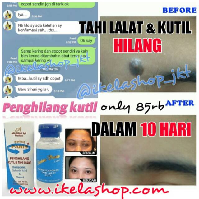 Swiss Paris Penghilang Tahi Lalat & Kutil