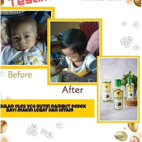 Barang Pilihan Vco Sr12 Virgin Coconut Oil Vico Oil Minyak Kelapa Murni Penambah Imun Tubuh Obat K Shopee Indonesia