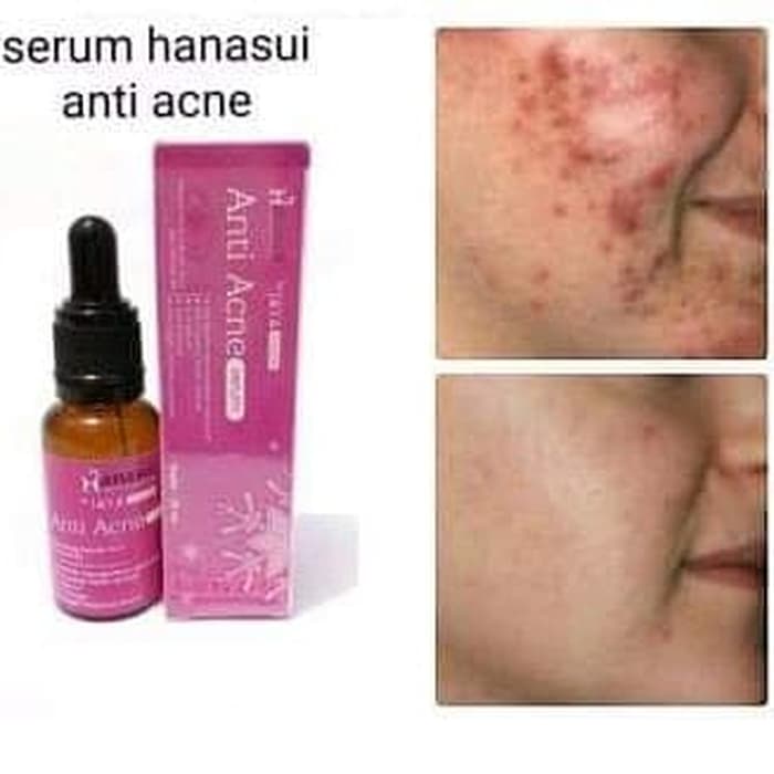 ORIGINAL Hanasui Serum Anti Acne Penghilang Jerawat dan Bekas Jerawat Memutihkan Wajah BPOM
