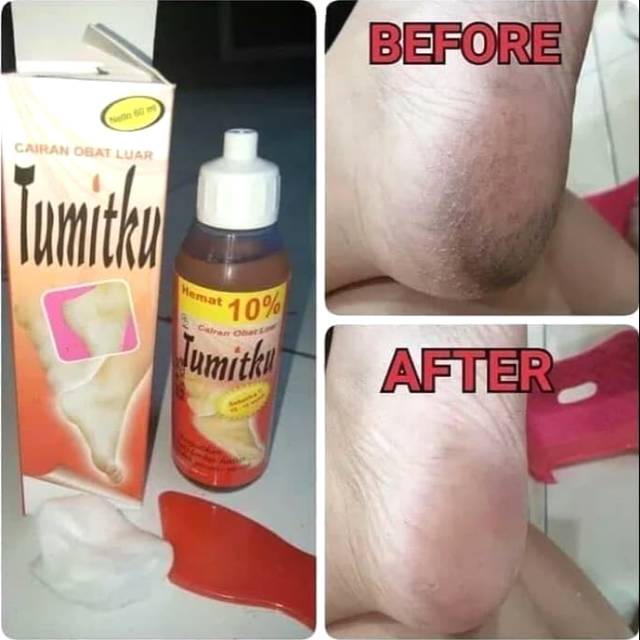 (COD) Obat Tumit Kaki Paling Ampuh, Obat Kapalan, Obat Telapak Kaki Pecah-pecah Kasar Kering