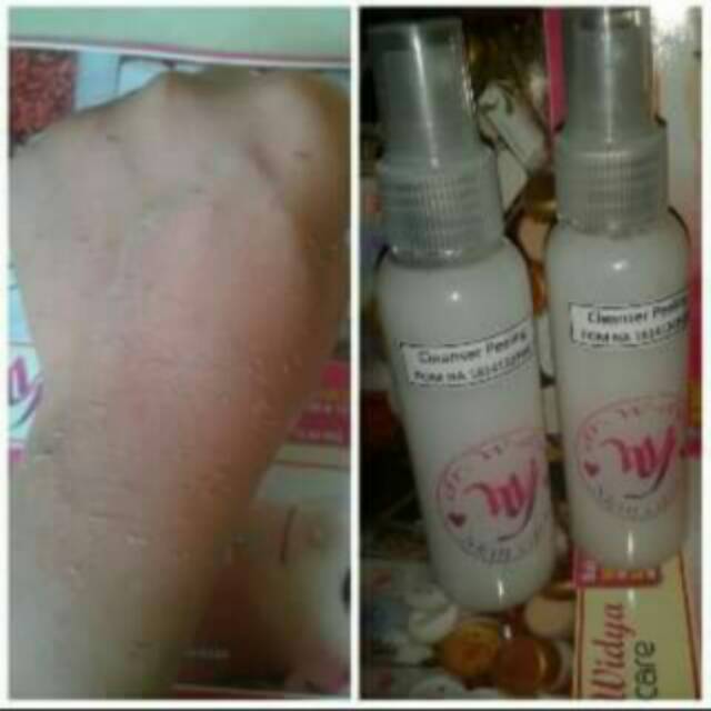 Peeling dr widya