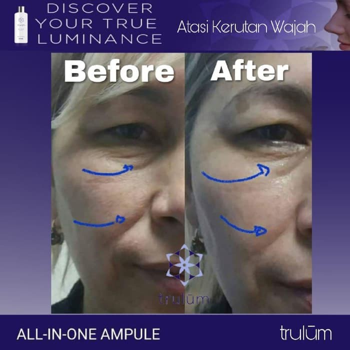 Trulum 15ml 5ml 120ml Flek Hitam Di Hidung Susah Hilang