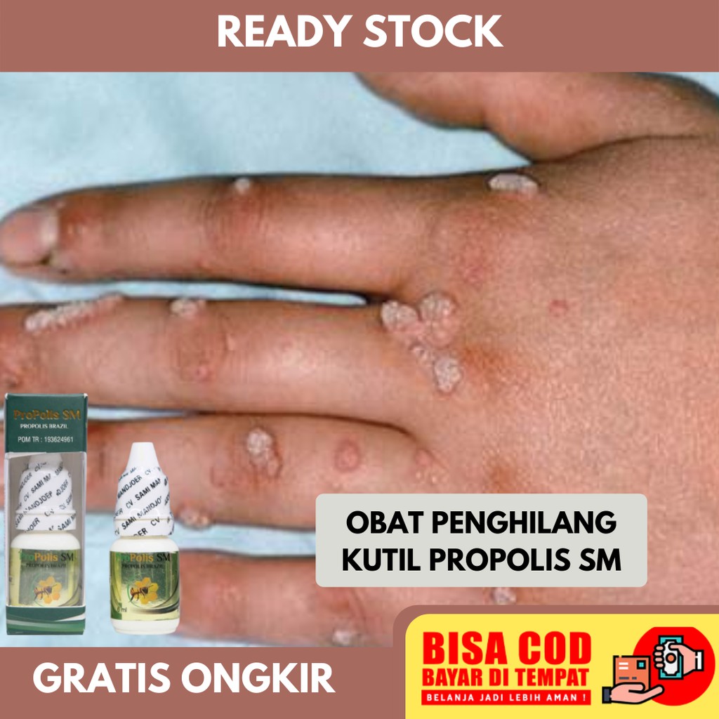 Obat Kutil Di Tangan, Penumpas Kutil Di Siku, Telapak, Dan Jari-jari Tangan Atau Kaki, Penghilang Ku