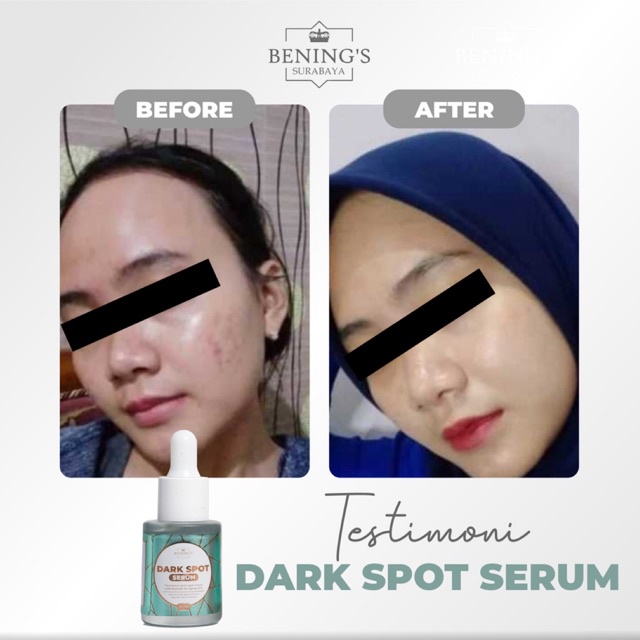 BENING'S SERUM DARK SPOT | MENGATASI FLEK, MELASMA &amp; MENCERAHKAN | FREE GIFT SIAP KIRIM SELURUH INDONESIA