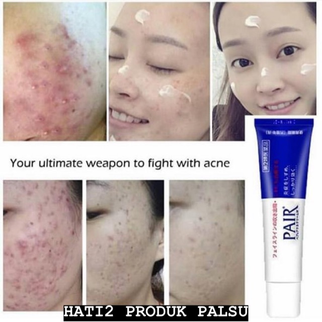pair acne cream palsu