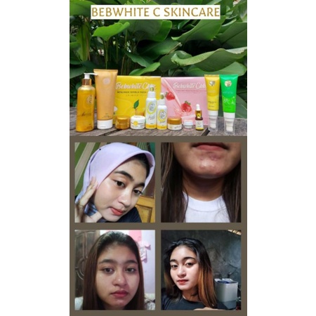 BEBWHITE C BBC ACNE SERIES UNTUK PEMULA DAN BERJERAWAT