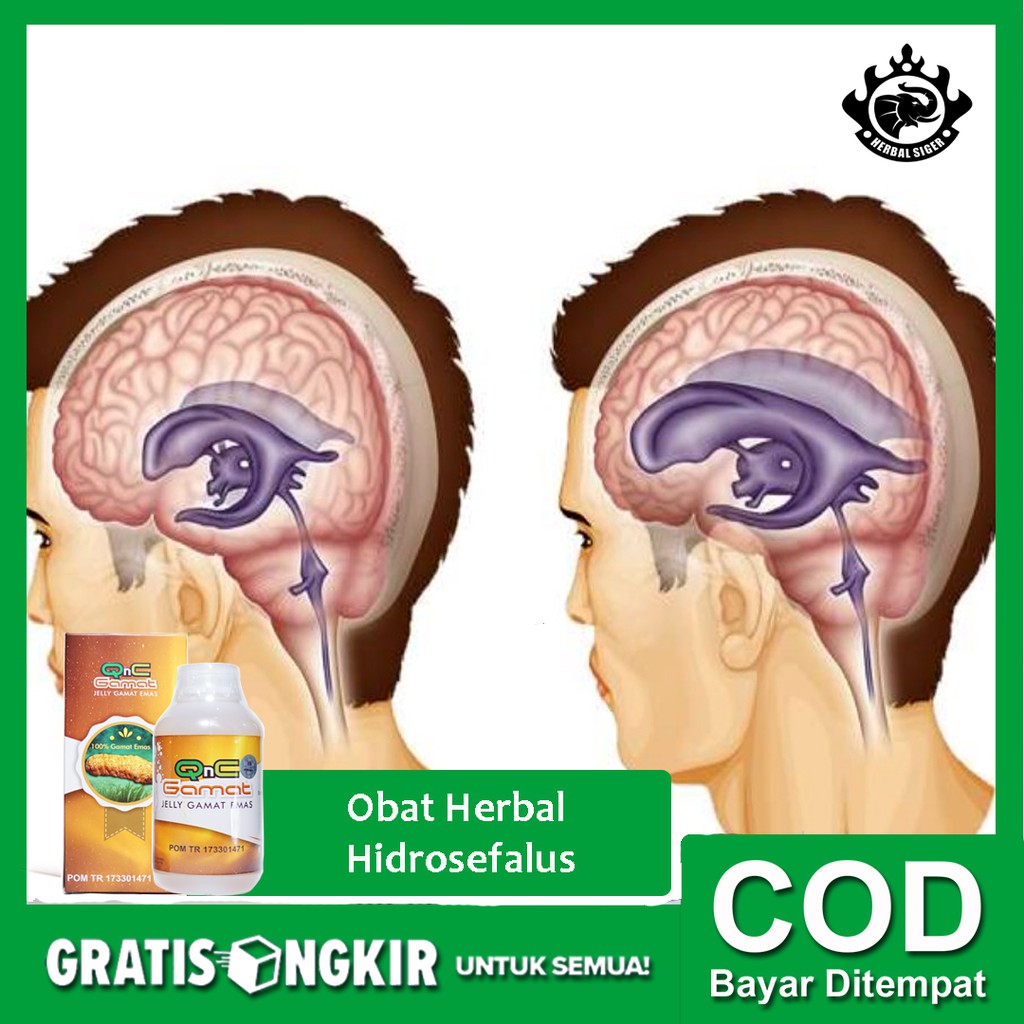 Obat Herbal Hidrosefalus, Hidrocefalus, Pembesaran Kepala QnC Jelly Gamat ASLI - Bisa COD - HALAL