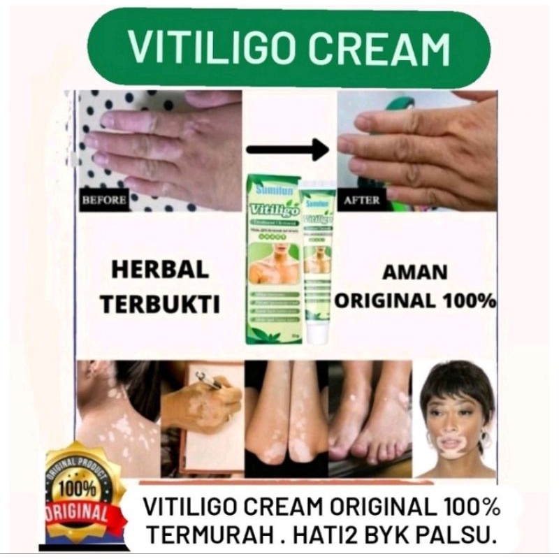 READY SALEP VITILIGO ORI 100% SEMBUH  cream psolaren solaren import