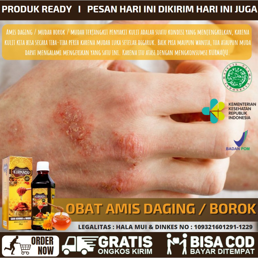 Obat Borok Menahun, Obat Sering Borok Akibat Daging Amis, Budug Menahun Untuk Anak & Dewasa KURMAQU
