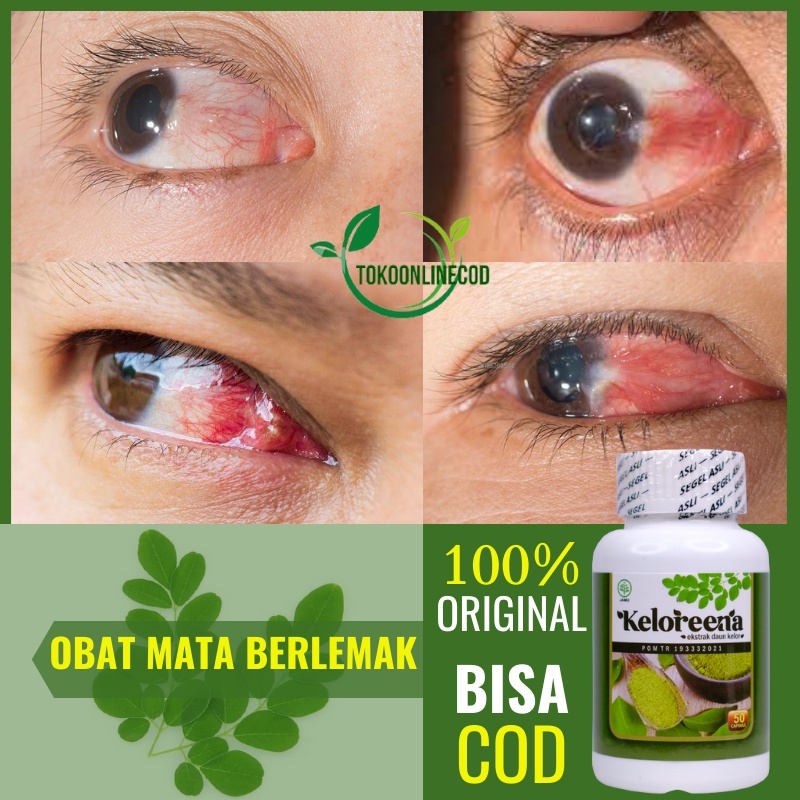 Obat Herbal Mata Berlemak, Pterygium / Pterigium, Pinguecula, Bintik Kuning Menahun, Keloreena Tidak