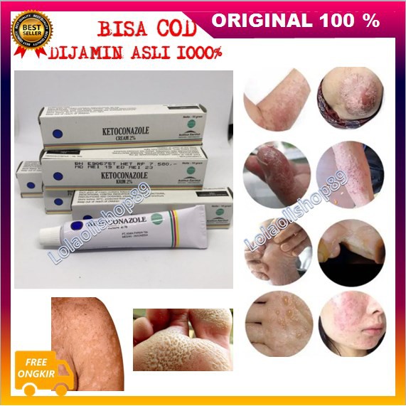 [BISA COD] Ketoconazole Salep Infeksi Jamur Panu Kurap Kadas Kutu Air Ampuh BPOM ASLI