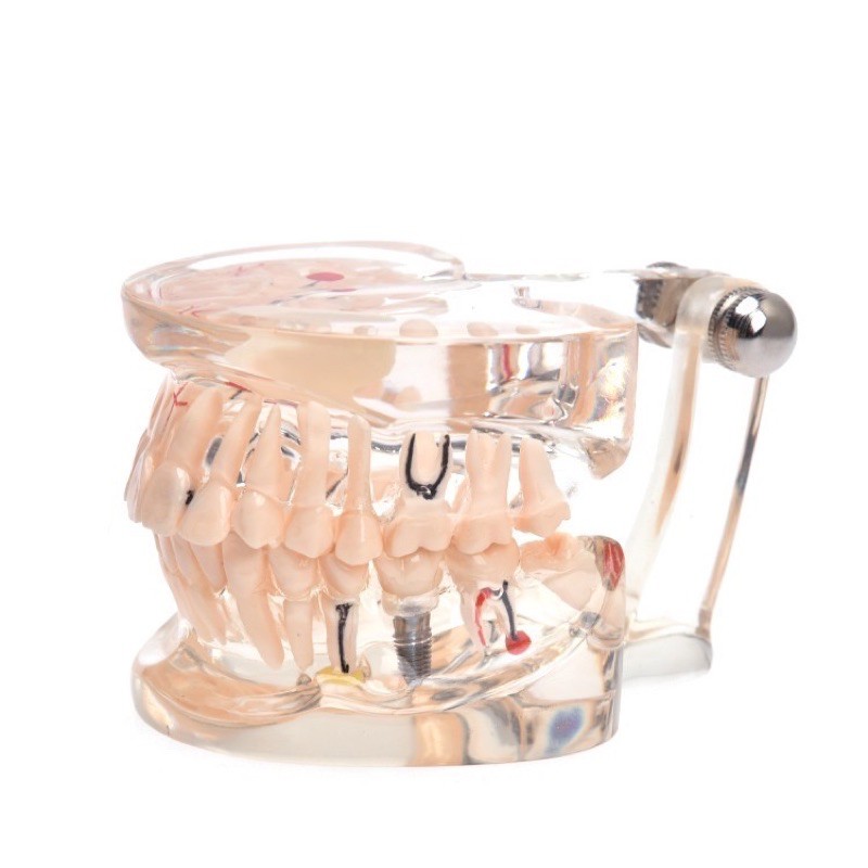 Dental Study Model Gigi Orthodontic Malocclusion PVC + Resin / Patung Gigi Phantom Bisa Di Lepas